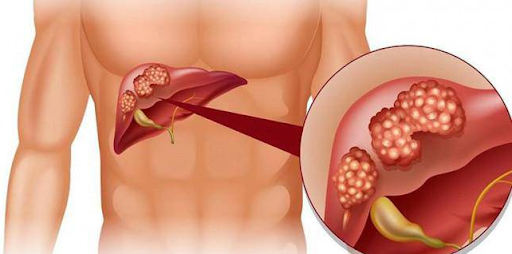 Rakovina jater Priznaky diagnostika a moznosti lecby 2