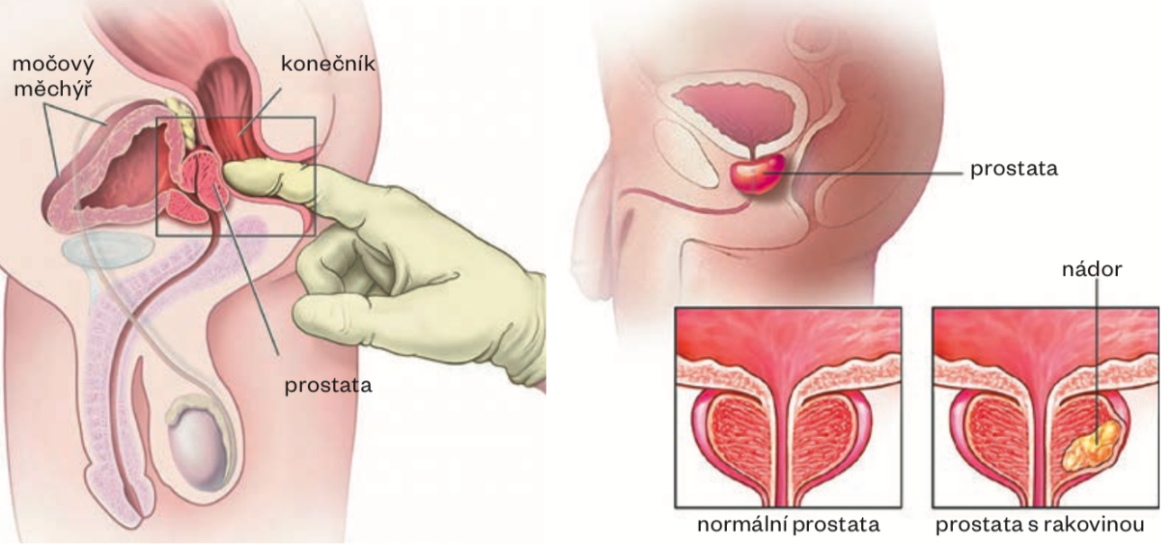 Rakovina prostaty Priznaky a moznosti lecby 2