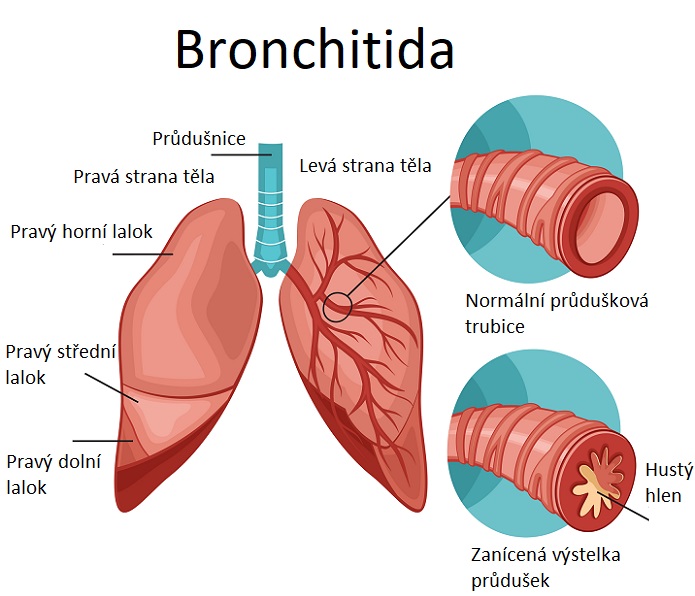 Zanet prudusek Bronchitis – Co potrebujete vedet 2