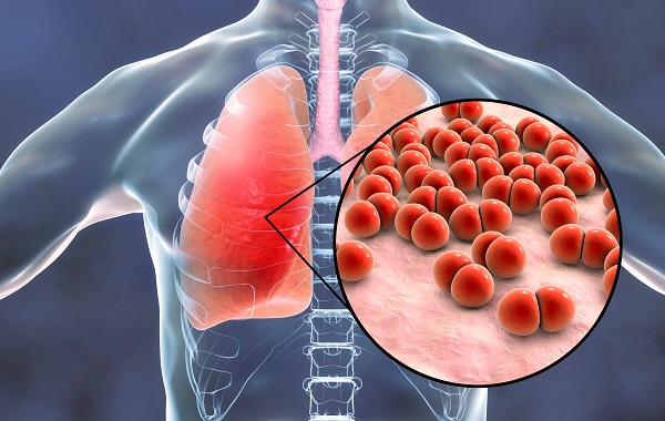 Zapal plic Pneumonia – Vse co potrebujete vedet 1