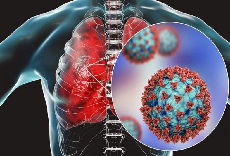 Zapal plic Pneumonia – Vse co potrebujete vedet 2