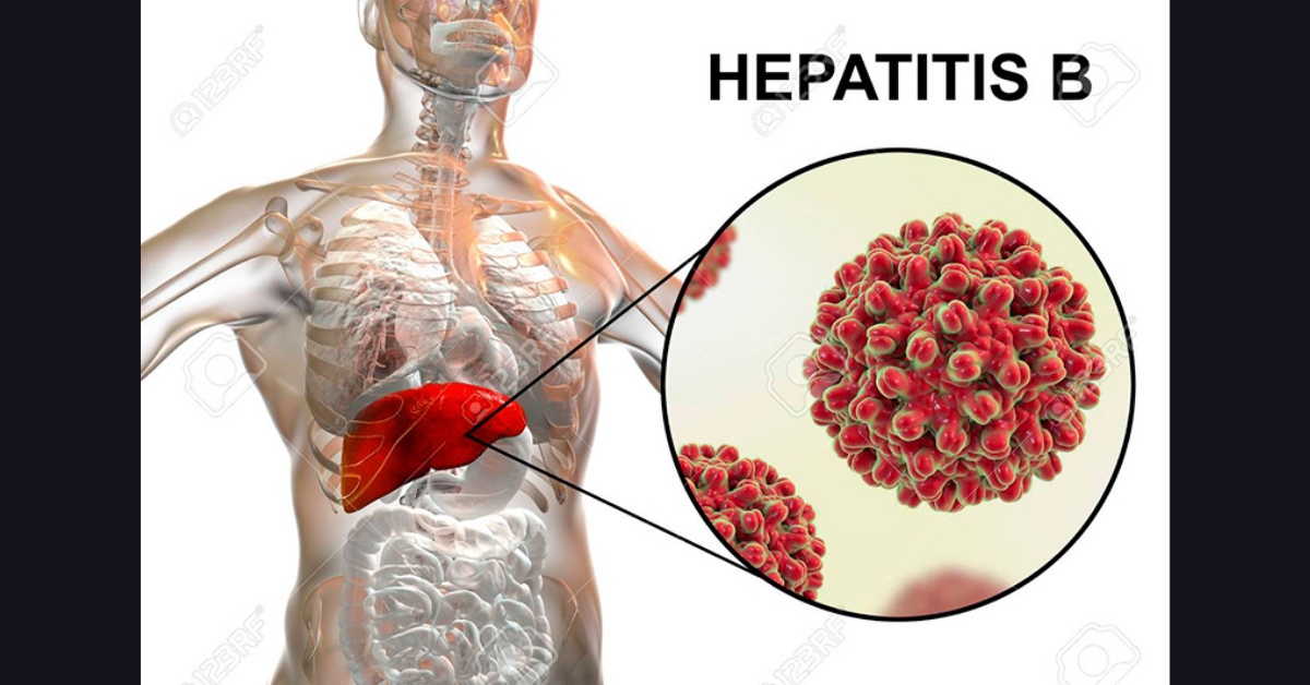 Hepatitida B (Hepatitis B) – Vše, co potřebujete vědět