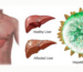 Hepatitida C (Hepatitis C) – Vše, co potřebujete vědět