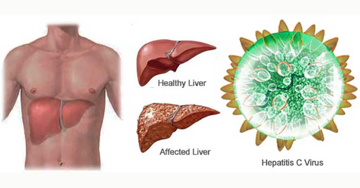 Hepatitida C (Hepatitis C) – Vše, co potřebujete vědět